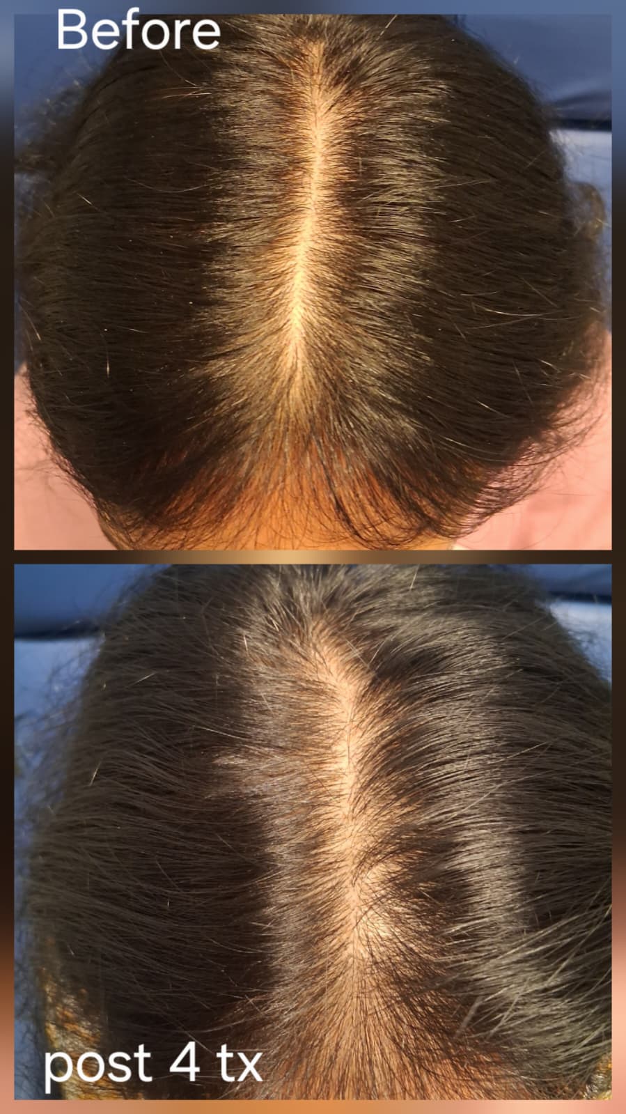 Hair restoration result